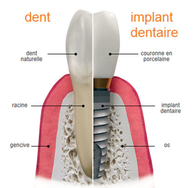 implant-img1